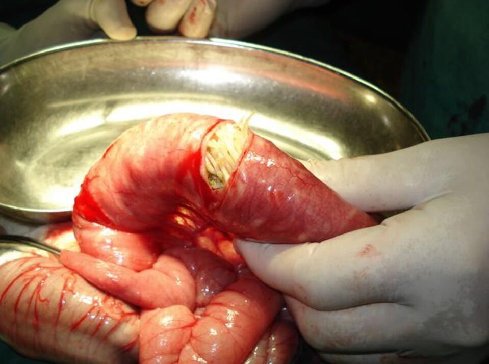 Round worms in the human gut